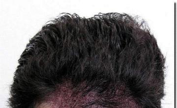 Hair restoration procedure results