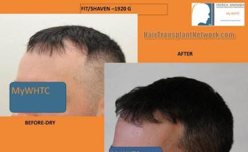 Hair transplantation surgery before and after images