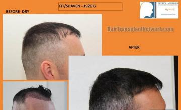 Hair transplantation surgery before and after photos