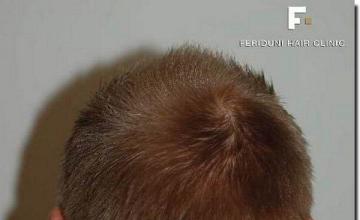 Hair restoration procedure results