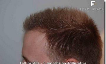 Hair restoration procedure results