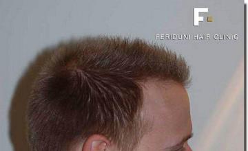 Hair restoration procedure results