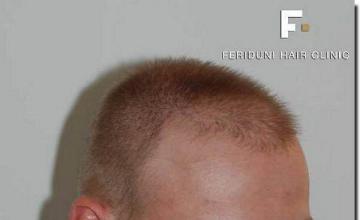 Hair restoration procedure results