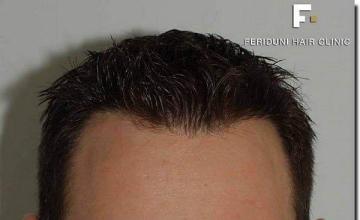 Hair restoration procedure results