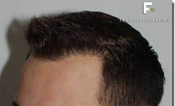 Hair restoration procedure results