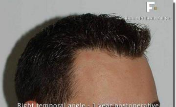 Hair restoration procedure results