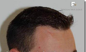 Hair restoration procedure results