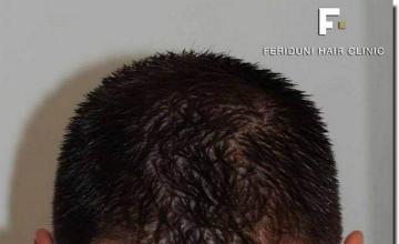 Hair restoration procedure results