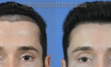 Dr. Steven Gabel | Hair transplant before and after photos
