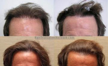 Hair transplant before and after photos - Front view