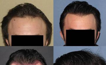 Front view before and after hair transplant