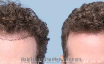 Front view - Before and after