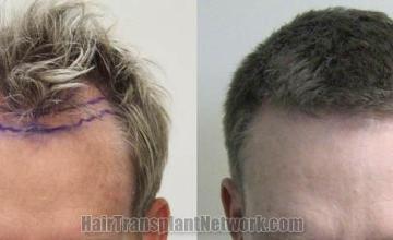 Hair restoration procedure before and after results