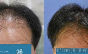 Front view - Before and after