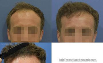 Hair restoration procedure before and after results