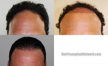 Front view - Before and after