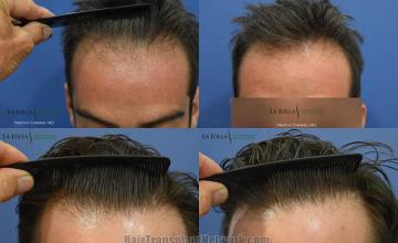 Hair restoration repair procedure before and after pictures