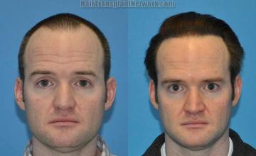 Front view - Before and after hair transplantation surgery