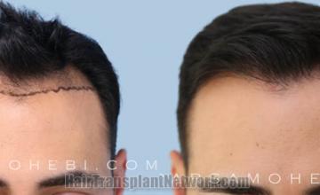 Front view - Before and after