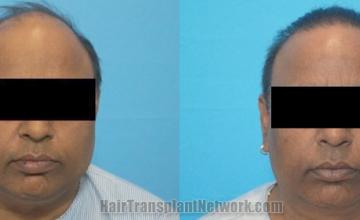 Front view - Before and after