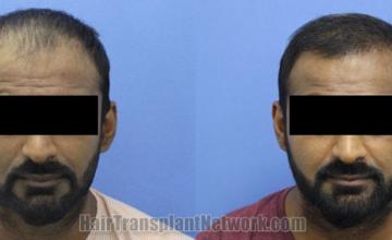 Front view - Before and after