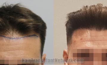 Front view - Before and after