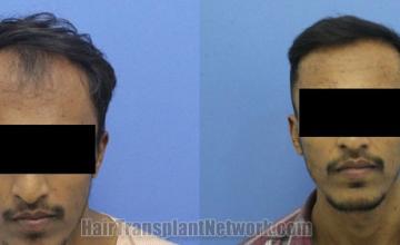 before and after result photographs