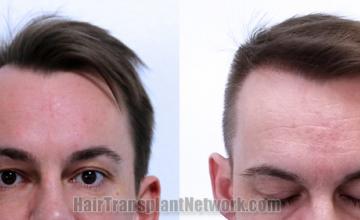 Front view - Before and after