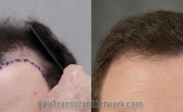 Front view - Before and after