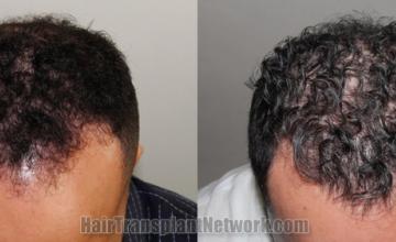 before and after result photographs