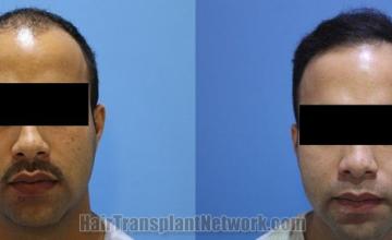 Front view - Before and after