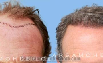 Front view - Before and after