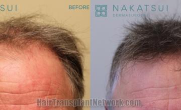 before and after result photographs