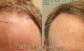 Front view - Before and after