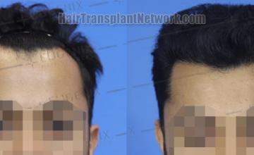 Front view - Before and after