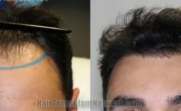 Front view - Before and after