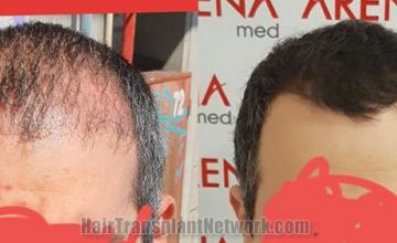 before and after result photographs