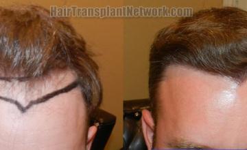 Front view - Before and after