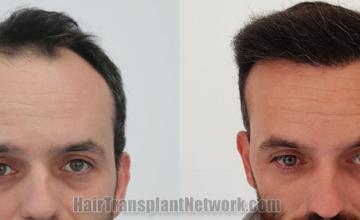 Front view - Before and after