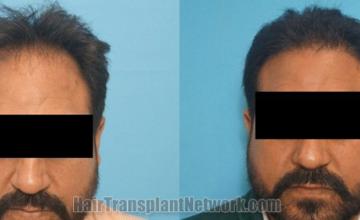 Front view - Before and after