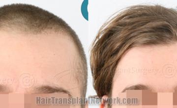 Front view - Before and after