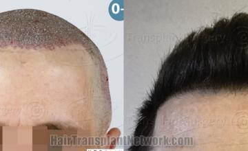 before and after result photographs