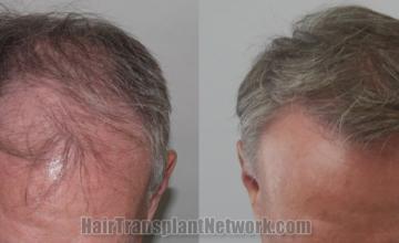 Front view - Before and after