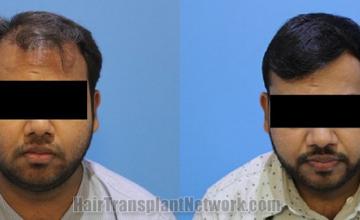 Front view - Before and after