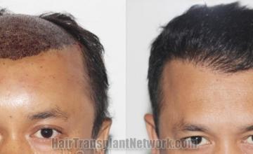 before and after result photographs