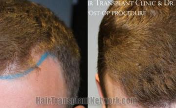 Front view - Before and after