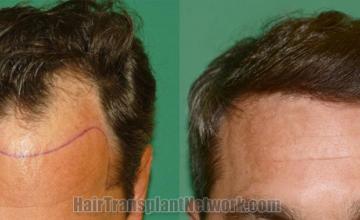 before and after result photographs