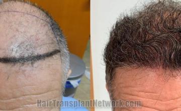 Front view - Before and after