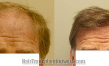 Front view - Before and after