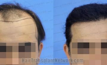 Front view - Before and after